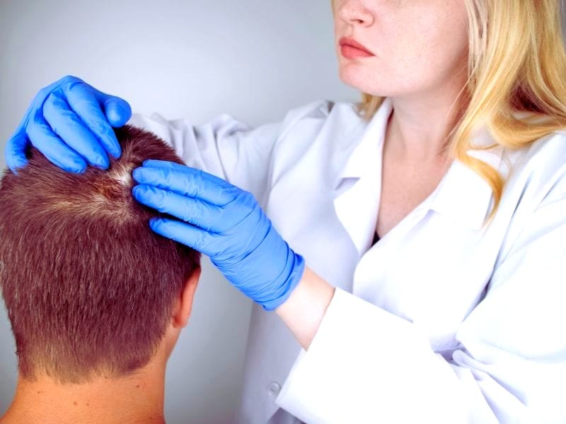 Doctor in gloves examining scalp of man with hair thinning or bald spot during hair loss check.