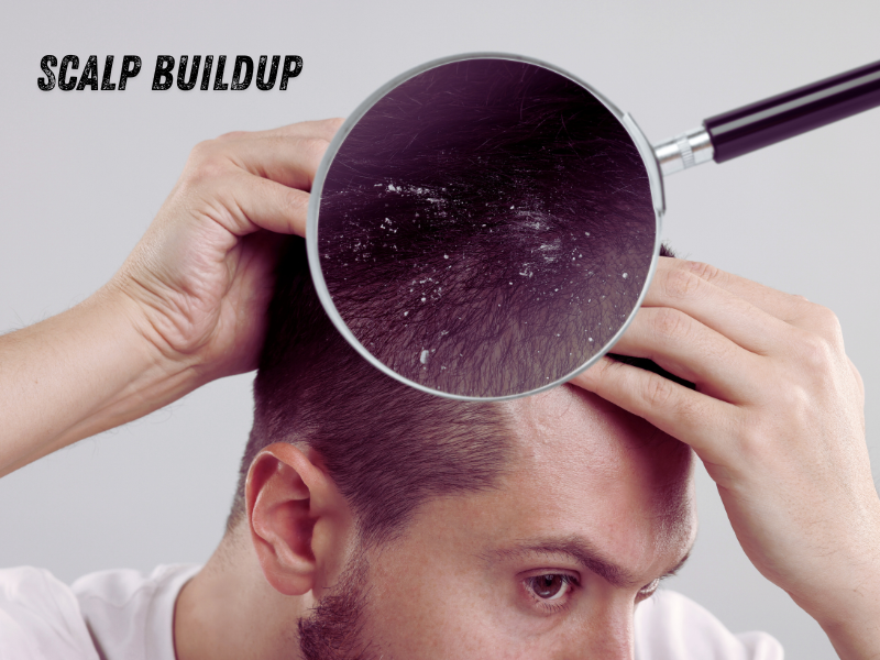 Man inspecting scalp buildup with magnifying glass highlighting dandruff and residue on hair.